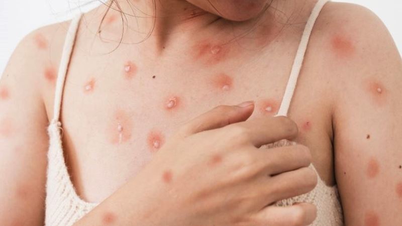 Cacar Monyet Atau Monkey Pox Mpox
