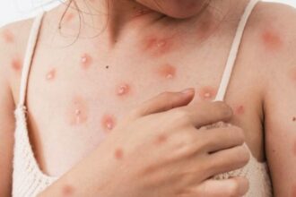 Cacar Monyet Atau Monkey Pox Mpox