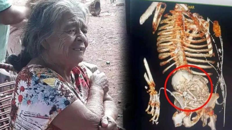 Ada Janin Di Perutnya Setelah 50 Tahun