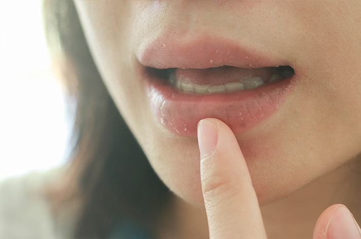 Perlu Tahu Ini 4 Cara Mengatasi Bibir Kering Secara Alami Halodoc