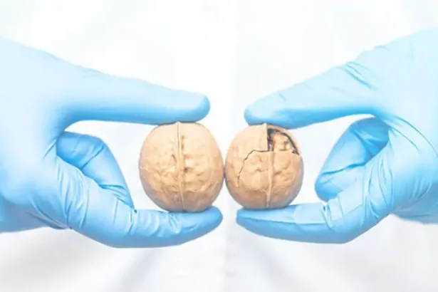 Ilustrasi Tumor Testis