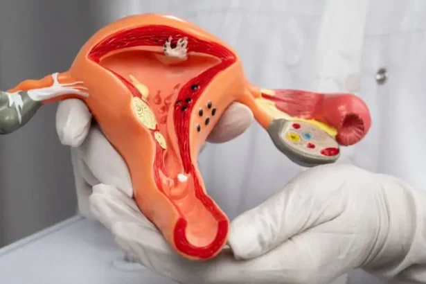 Gejala Kanker Serviks