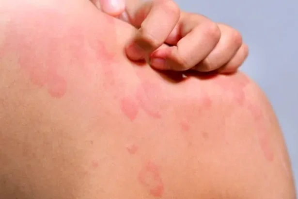 Cara Cepat Hilangkan Biduran