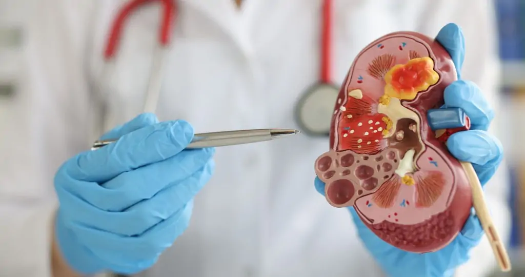 Ilustrasi Gejala Infeksi Ginjal