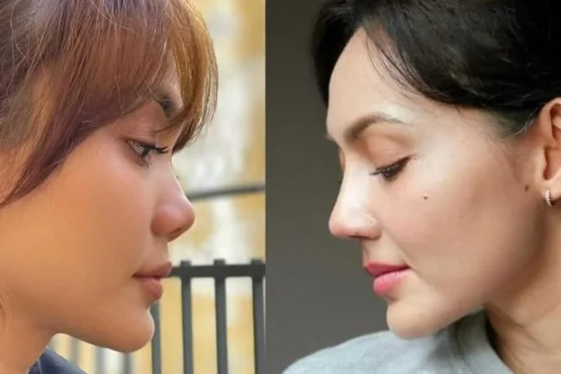 Rina Nose Oplas Hidung