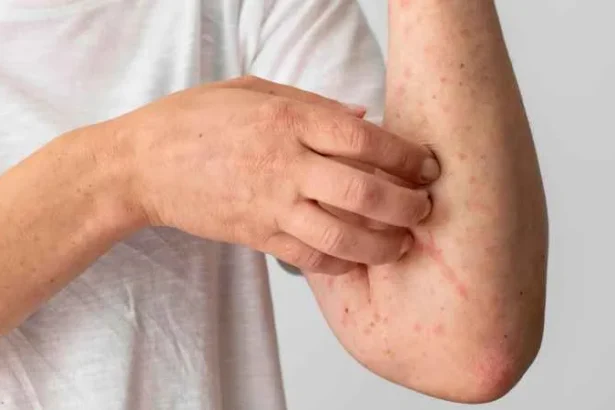 Gejala Ciri Ciri Campak Pada Orang Dewasa